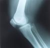 Американские ученые предложили новый способ идентификации личности: по рентгеновскому снимку коленного сустава