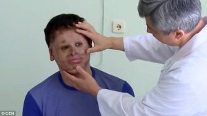 В ККБ № 1 провели уникальную операцию по пересадке кожи лица