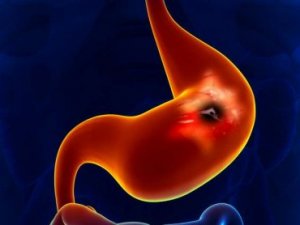 Создан альтернативный ФГС  и эндоскопии тест для диагностики рака пищевода и  желудка