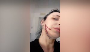 В Воронеже банк принес извинения клиентке, чью щеку сотрудница проткнула ручкой