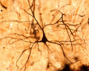Ученые описали, как нервные клетки теряют свои отростки при нейродегенерации