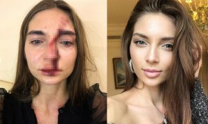 Сломали нос и пробили голову: Певицу избили в клинике