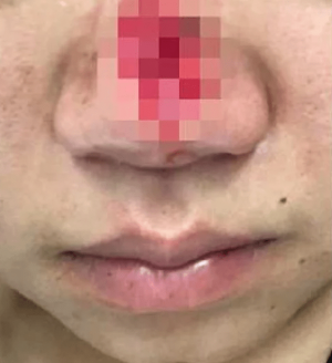 Жительница Сочи откусила матери кончик носа во время семейной ссоры