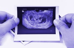 Каждая четвертая живущая в Финляндии русская или эстонка сделала как минимум три аборта – из финок каждая десятая.