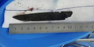Мужчина прожил 26 лет с десятисантиметровым ножом в голове