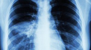 "Шокирующе": почти все, кто выздоровел от Covid-19, имеют проблемы со здоровьем месяцами позже