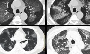 Эксклюзив: некоторые пациенты EVALI 2019 года в США могли быть инфицированы COVID-19: источники