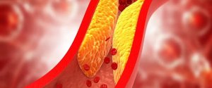Разработана нанотерапия для очистки артерий