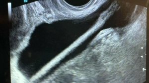 В Подмосковье врачи достали из мочевого пузыря женщины карандаш