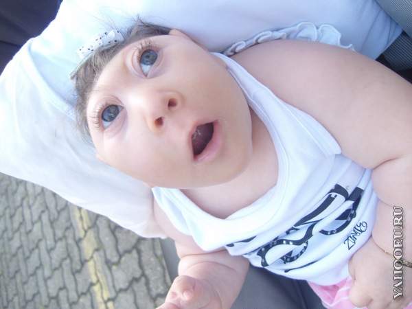 анэнцефалия